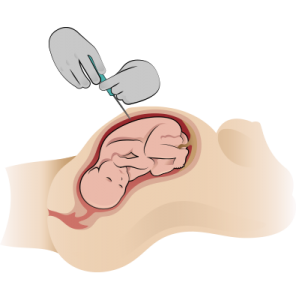 Amniocentesis involves extracting a small sample of cells from amniotic fluid.
