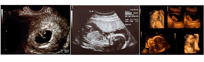 Ultrasound scans of the first weeks of pregnancy.