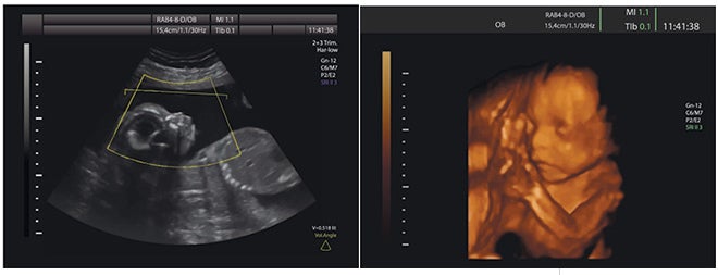Ultrasound scans at 18-24 weeks gestation.