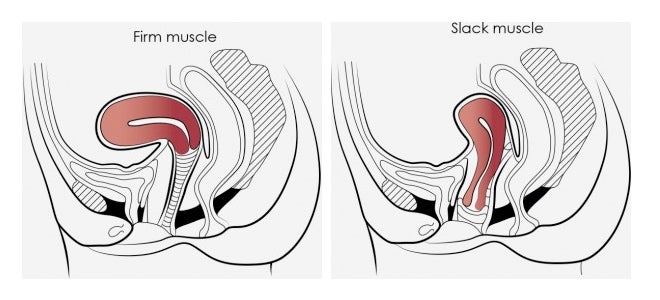 Difference between a firm and slack pelvic muscle.