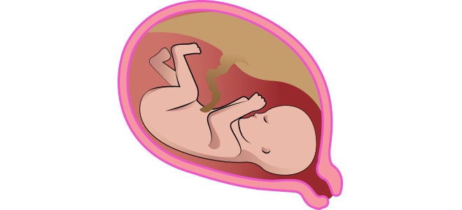 Second trimester fetus of a human baby.