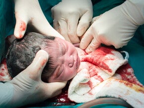 Caesarean birth Caesarean birth