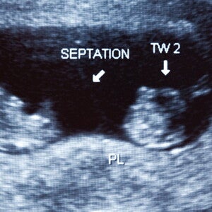 Multiple births