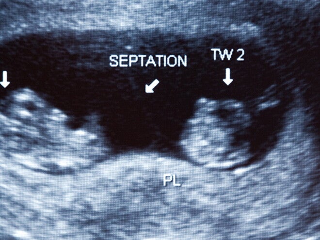 Multiple births Multiple births